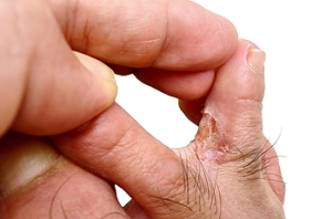 Symptoms and Treatment for Athlete&#039;s Foot