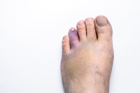 A Broken Toe Is a Common Foot Injury