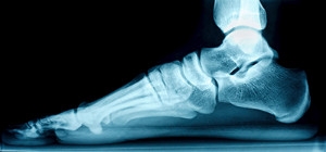 Various Reasons to Have Flat Feet