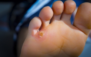 Seed Corns on the Feet