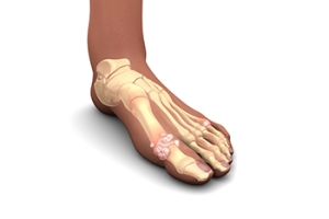 The Definition and Stages of Gout