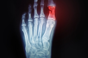 Key Signs to Look for in a Broken Toe