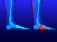 Various Reasons That Flat Feet Can Occur