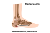 Causes and Prevention of Plantar Fasciitis