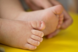 Ingrown Toenails in Infants