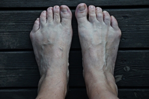 Bunionette Treatment